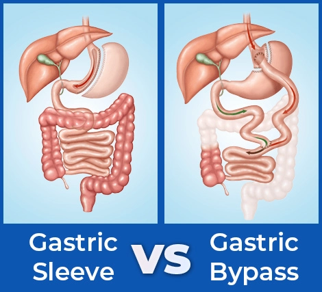 Gastric Sleeve and Gastric Bypass